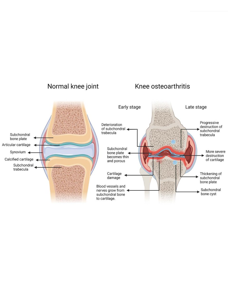 The signal transduction mechanism in subchondral bone (SB) is critical to the balance between cartilage and SB. The imbalance of signal transduction in SB will promote the occurrence and development of osteoarthritis.

#BJR #Arthritis #OrthoTwitter

ow.ly/QePh50WhxZv