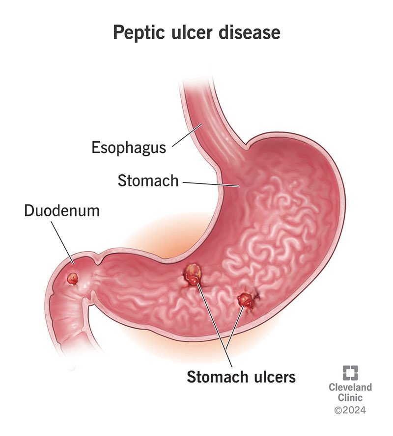 I Have ulcer.

I sabi my body, I don dey treat this ulcer since.
But no test. Just vibes and pepper pain. 🌶️
Let’s fix this.

Not every peppery chest pain is ulcer.
Some of you are treating dyspepsia, gas, or even heartburn — with the wrong drugs and some wasted money 

🧵 A