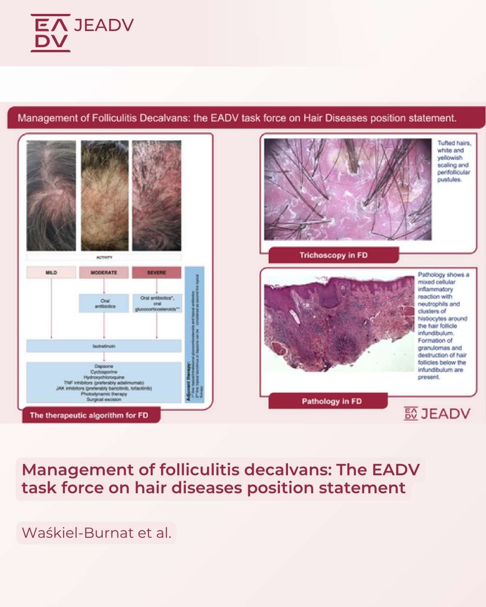 🆕 New #JEADV Position Statement! Waśkiel-Burnat et al. share expert guidance on #FolliculitisDecalvans, the most common neutrophilic scarring #alopecia.  

📚Key points: Oral antibiotics, Isotretinoin, Corticosteroids, Biologics, JAKi, PDT, Surgery.  

🔗doi.org/10.1111/jdv.20…