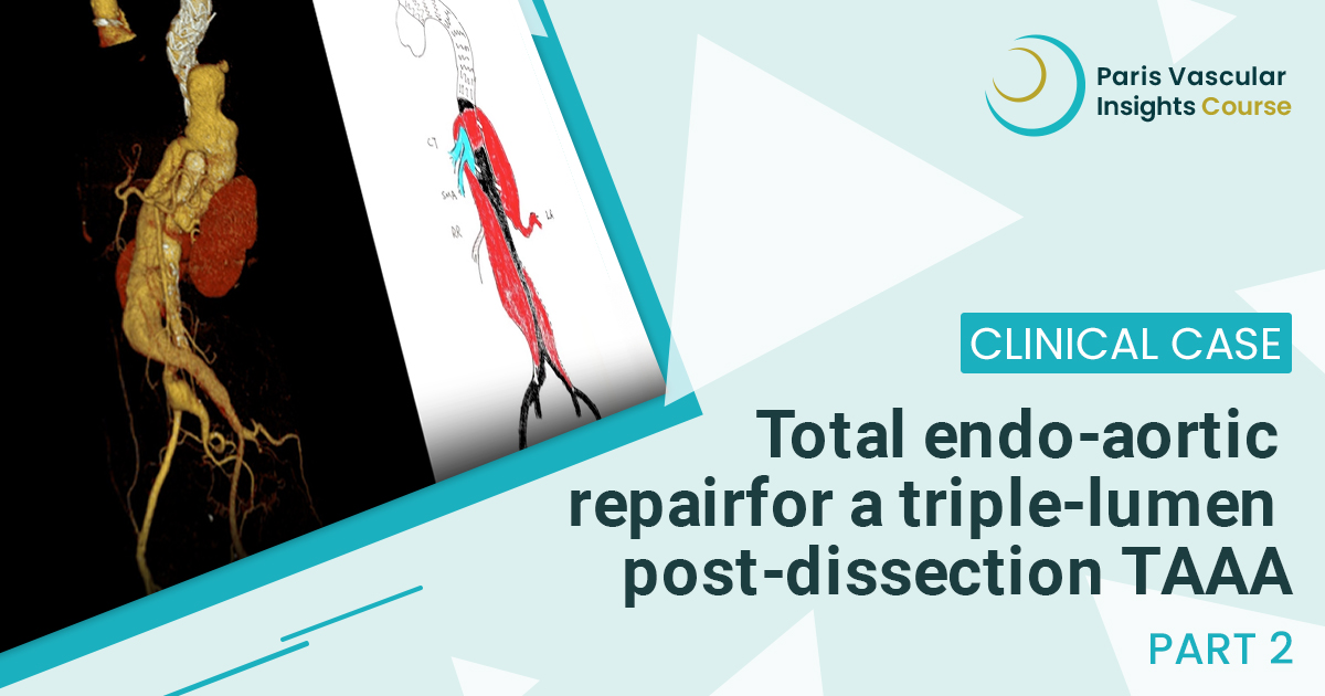 ParisVascular's tweet photo. Triple trouble: what was your call? 🧐
In this chaotic post-dissection #TAAA with two false lumens and a squeezed true lumen, most of you went for a bold #endovascular route.
Ready to see what really happened? ➡️ https://t.co/j023BeUEjN
#PVI #PVI25 #vascular https://t.co/P3QobYIjlM