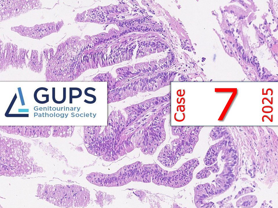 GU_Path_Society's tweet image. ** CASE OF THE MONTH  **

A glandular lesion in the bladder with serrated morphology.

gupathsociety.org/interesting-ca…

#GUPSCOW #GUpath #pathology

FB: GU Pathology Society 
Thread and IG: gu_pathology_society
LinkedIN: GUPS Society
Bluesky: gupathsociety.bsky.social