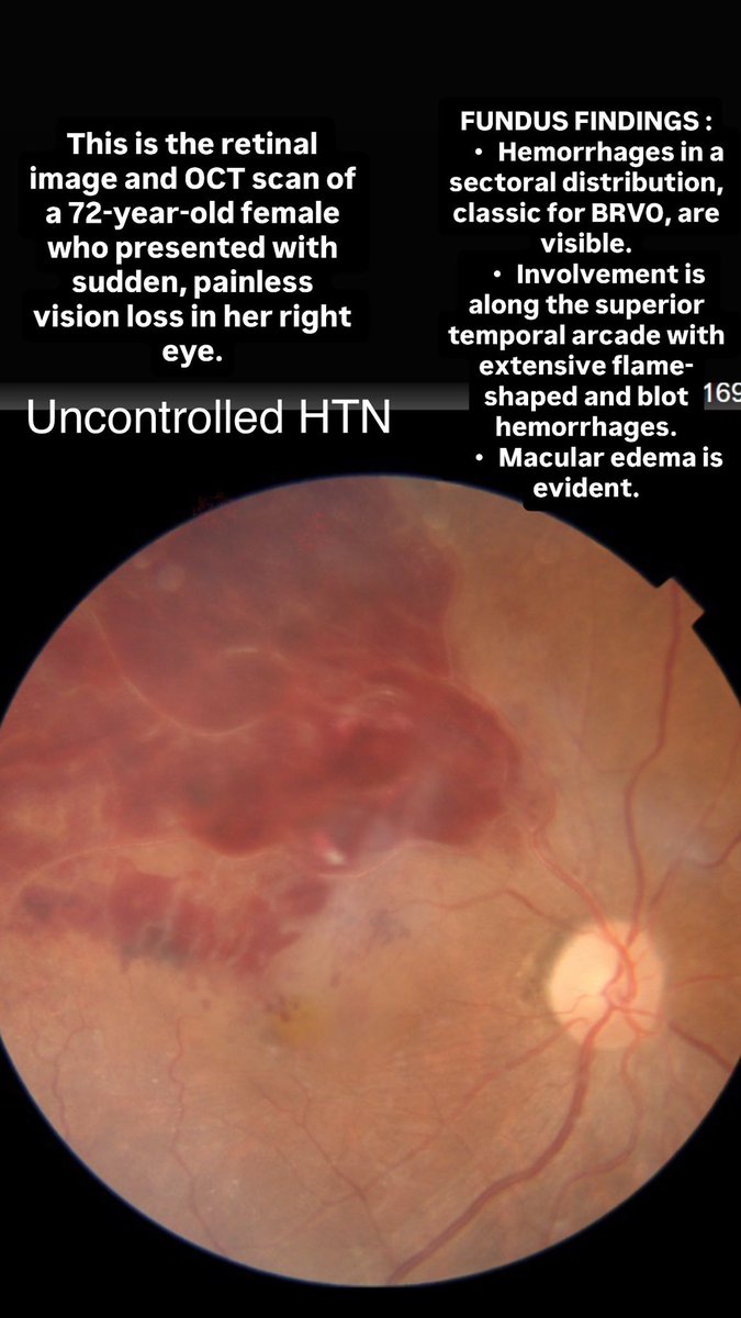 cuticulardrusen's tweet image. This is the retinal image and OCT scan of a 72-year-old female who presented with sudden, painless vision loss in her right eye. IVI Ranibizumab given today. 

#BRVO #RetinaCare #OCT #RetinalImaging #MacularEdema #Ophthalmology #VisionHealth #FundusPhotography #RetinaSpecialist