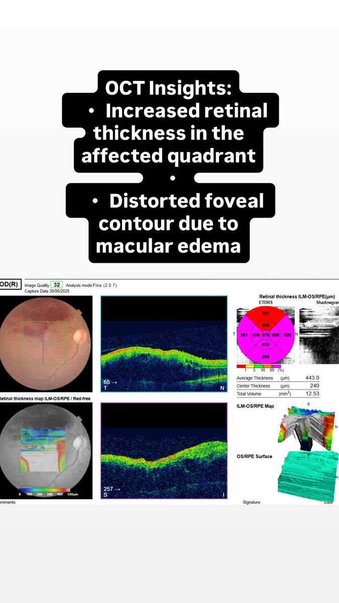 cuticulardrusen's tweet image. This is the retinal image and OCT scan of a 72-year-old female who presented with sudden, painless vision loss in her right eye. IVI Ranibizumab given today. 

#BRVO #RetinaCare #OCT #RetinalImaging #MacularEdema #Ophthalmology #VisionHealth #FundusPhotography #RetinaSpecialist