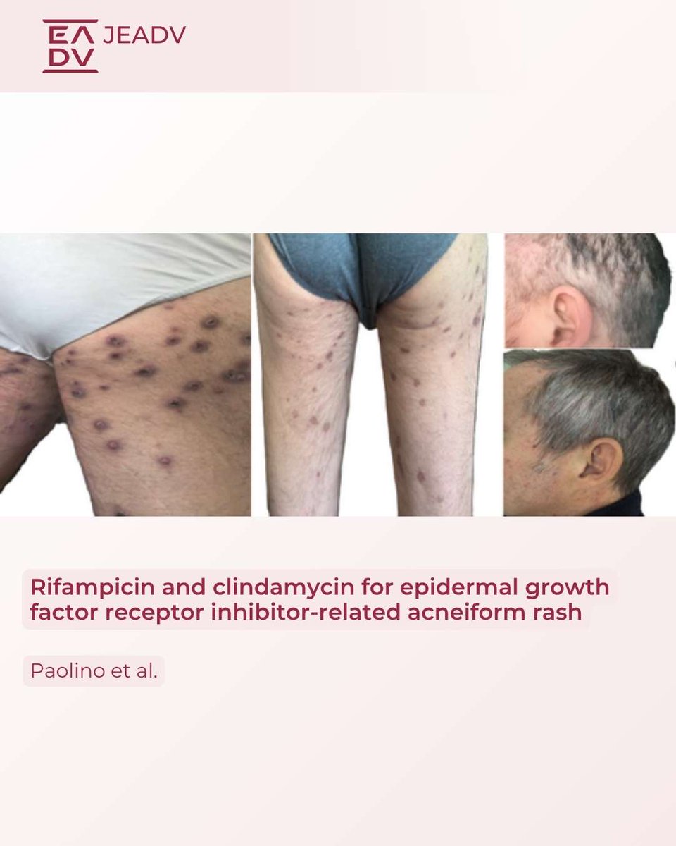 💊 Paolino et al. report that #rifampicin plus #clindamycin effectively reduce #EGFR inhibitor–related #acneiform #rash by lowering #inflammatory #cytokines and neutrophil chemotaxis.   

🔗 Discover the clinical insights: doi.org/10.1111/jdv.20… 

#Oncodermatology