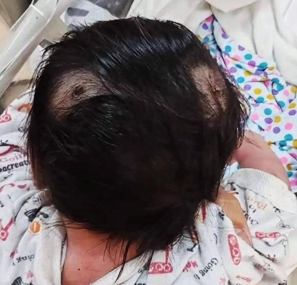 The one-month-old baby who was shot in the head by an Israeli sniper in Gaza has survived. I see no one sharing. If he were dead, everyone would share! Share positivity...