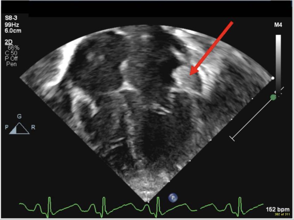 First reported case of neonatal intracardiac thrombosis linked to transplacental transfer of maternal aCL antibodies. Highlights importance of aPL testing in unusual #NeonatalThrombosis. Case study only; not representative of all OAPS patients: pmc.ncbi.nlm.nih.gov/articles/PMC12…