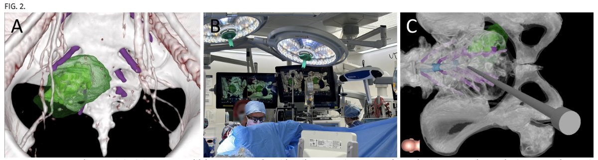 #JNSCaseLessons: Authors detail their initial experience using patient-specific 3D modeling for surgical planning in two cases of sacral tumor resection. 

thejns.org/caselessons/vi…