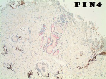Ankur Sangoi (@slusagar) on Twitter photo TURP for BPH, with focal (subtle!) incidental Gleason grade 3+3 
Although not specific for prostate cancer, to quote my #GUpath mentor & friend Jesse McKenney:
"respect the crystalloid" TURP for BPH, with focal (subtle!) incidental Gleason grade 3+3 
Although not specific for prostate cancer, to quote my #GUpath mentor & friend Jesse McKenney:
"respect the crystalloid"