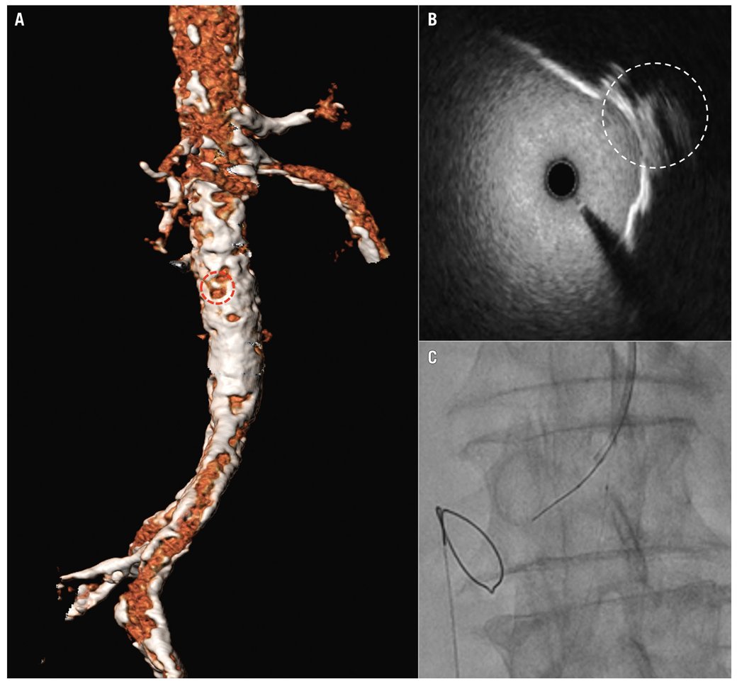 When transfemoral access is not feasible for #TAVI, transcaval access may offer a solution.
This case showed a modified #transcaval approach using IVUS to navigate severe aortic calcification, enabling safe valve delivery in a high-risk patient.
ow.ly/1O1l50W75hh
 #EAPCI