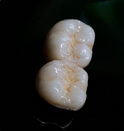 TheLabProtesis's tweet image. En ocasiones nos entran trabajos de este estilo, que cada vez se realizan menos, una corona metal-cerámica.
En esta se aprecian todo tipo de detalles!

¿Quieres contratar nuestros servicios? No dudes en llamar al 913-230-700, o escríbenos!