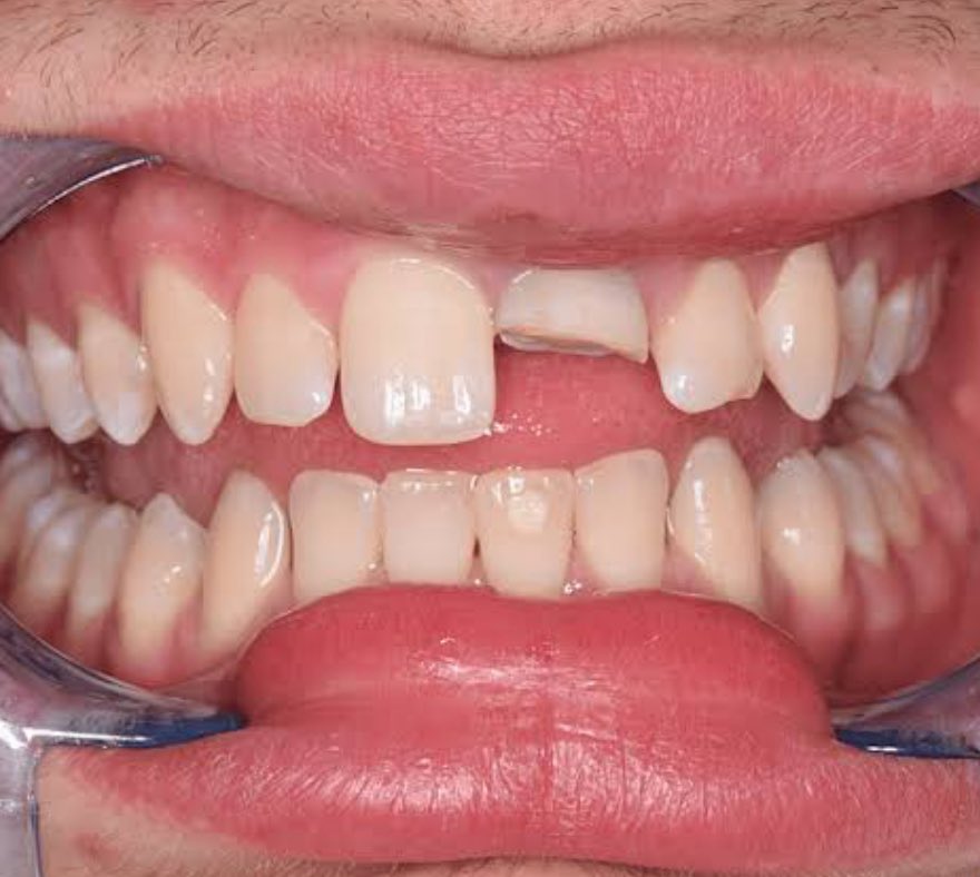 toothfairy06's tweet photo. 🦷PERAWATAN GRATIS🦷
yang punya keluhan seperti di foto, diikuti gejala:
- gigi suka nyut2an tiba2 
- gigi sakit ketika diketuk
- gigi patah
- gigi berlubang besar

❗️GIGI DEPAN only❗️ perawatan di salemba, jakpus
#tds4injakarta #canwejustpause #eaJ1EP #TrendingNow #LoveIsland https://t.co/olUoAnTbpm