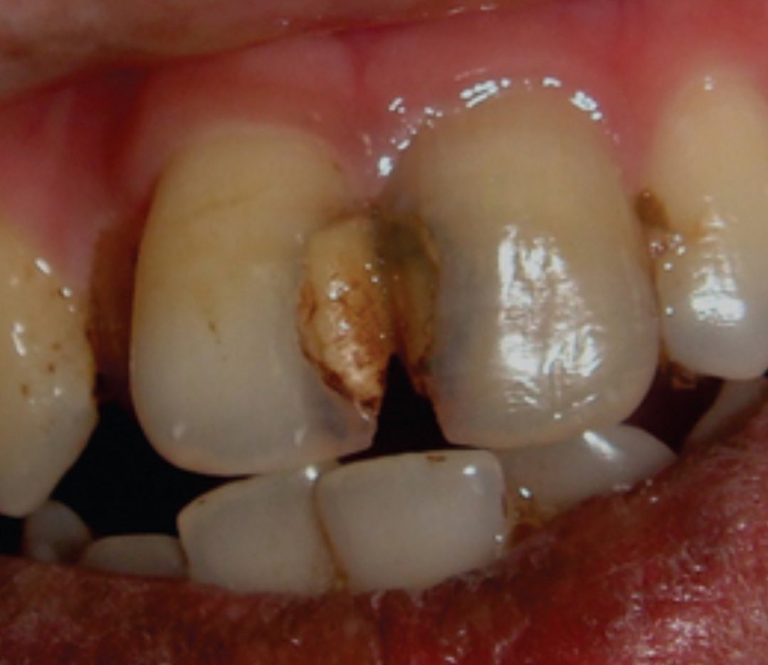 toothfairy06's tweet photo. 🦷PERAWATAN GRATIS🦷
yang punya keluhan seperti di foto, diikuti gejala:
- gigi suka nyut2an tiba2 
- gigi sakit ketika diketuk
- gigi patah
- gigi berlubang besar

❗️GIGI DEPAN only❗️ perawatan di salemba, jakpus
#tds4injakarta #canwejustpause #eaJ1EP #TrendingNow #LoveIsland https://t.co/olUoAnTbpm