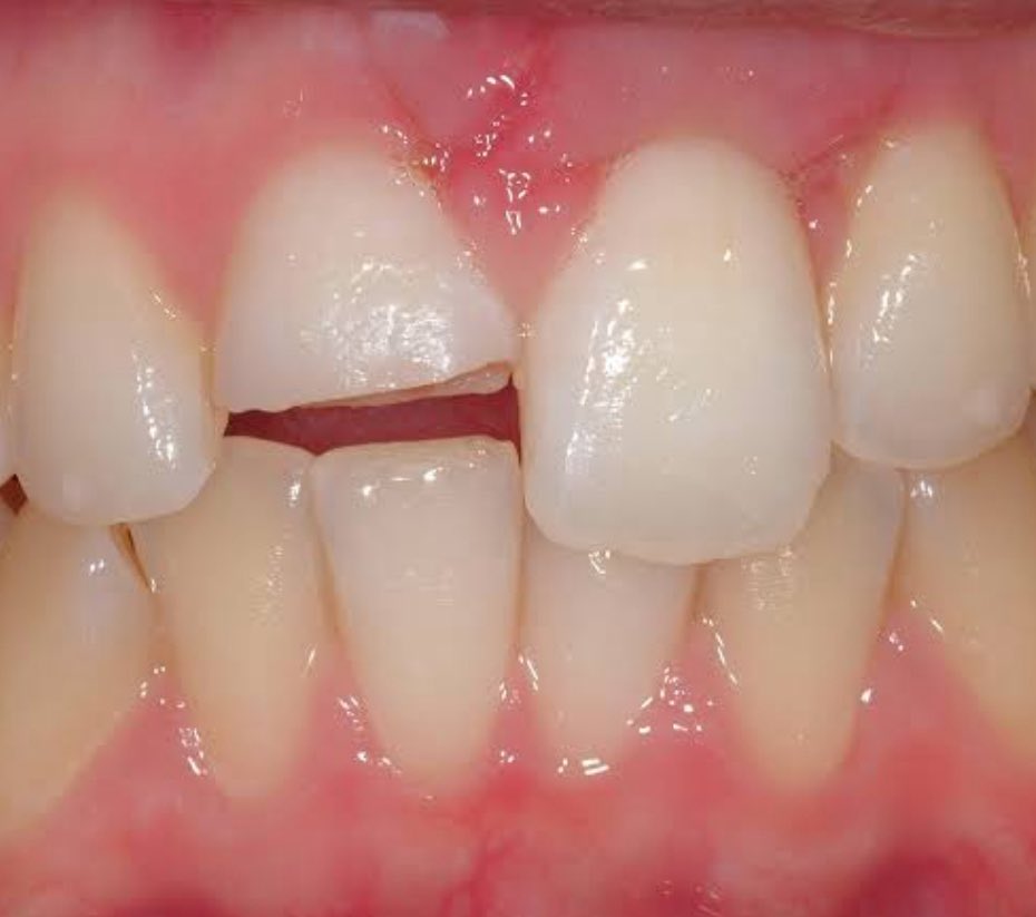 toothfairy06's tweet photo. ❗️DICARI PASIEN GIGI PATAH❗️
perawatan full gratis ditanggung aku yaa! bisa dm aku kalo kalian punya kondisi kaya gini:

#LoveIsland #Trending #TrendingNow #perawatangigigratis #MasterChefCelebrity #AHOF https://t.co/AmqjNW21sy