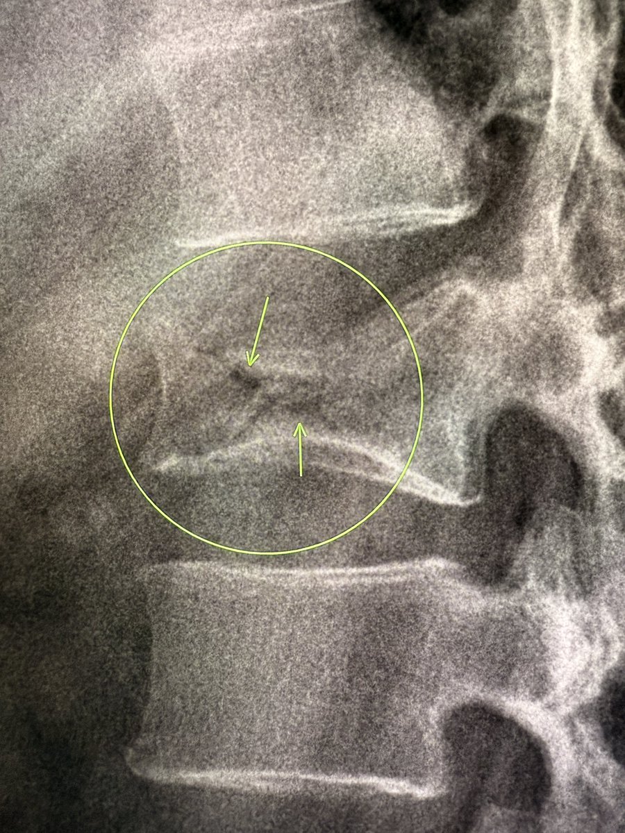 samrad77's tweet photo. Intravertebral vacuum cleft sign: air within the collapsed vertebral body. It occurs due to delayed post-traumatic collapse of the vertebral body, as a result of osteonecrosis and non-union of the fracture, also called Kümmell’s Disease. 

It can be seen on radiographs, but is better seen on CT. 

Seen usually in osteoporotic compression fractures, often weeks to months after injury.

—Classic radiology signs from my reporting list