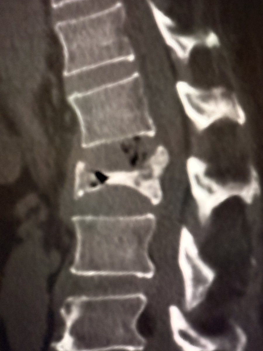 Intravertebral vacuum cleft sign: air within the collapsed vertebral body. It occurs due to delayed post-traumatic collapse of the vertebral body, as a result of osteonecrosis and non-union of the fracture, also called Kümmell’s Disease. 

It can be seen on radiographs, but is