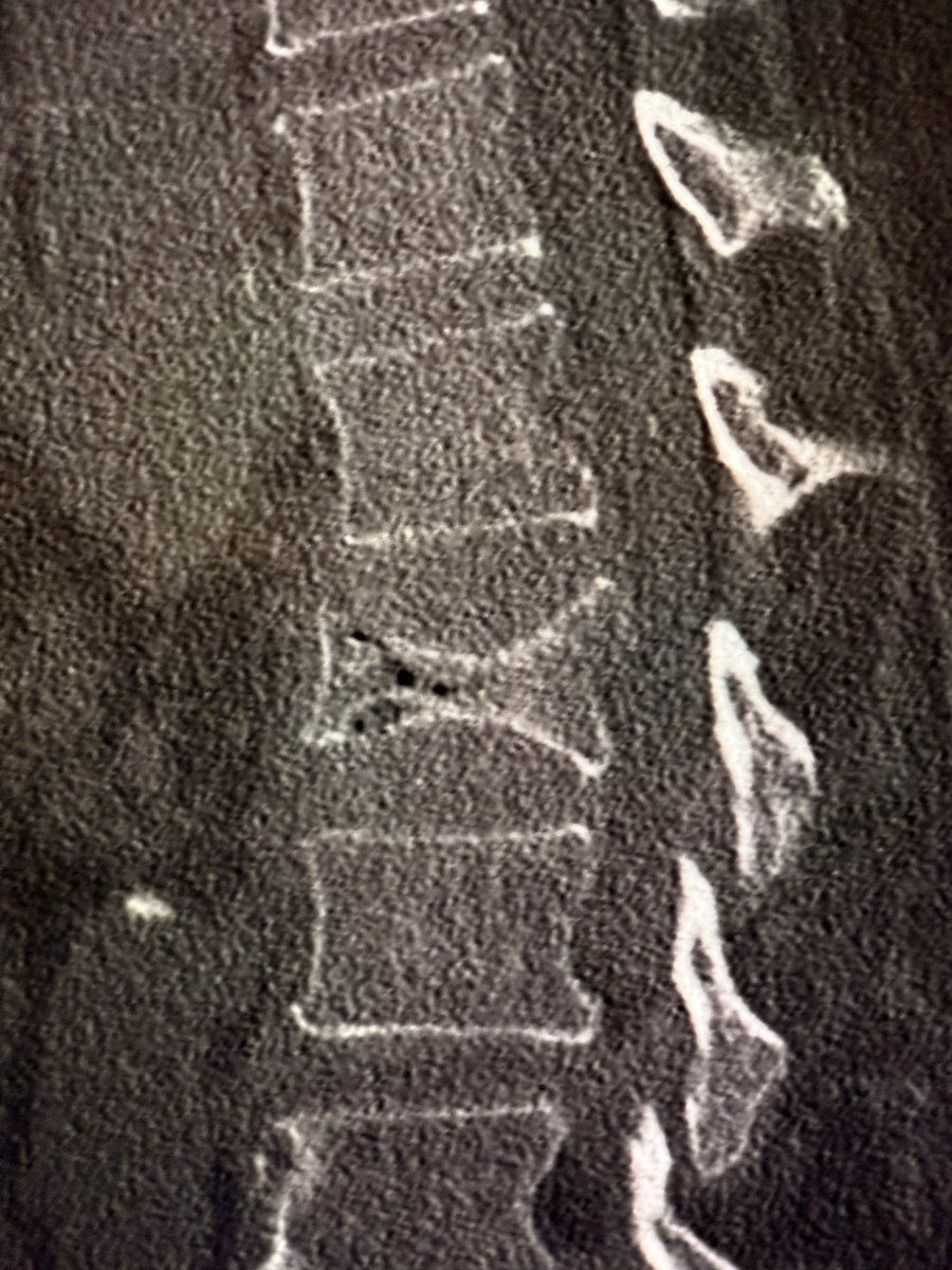 samrad77's tweet photo. Intravertebral vacuum cleft sign: air within the collapsed vertebral body. It occurs due to delayed post-traumatic collapse of the vertebral body, as a result of osteonecrosis and non-union of the fracture, also called Kümmell’s Disease. 

It can be seen on radiographs, but is better seen on CT. 

Seen usually in osteoporotic compression fractures, often weeks to months after injury.

—Classic radiology signs from my reporting list
