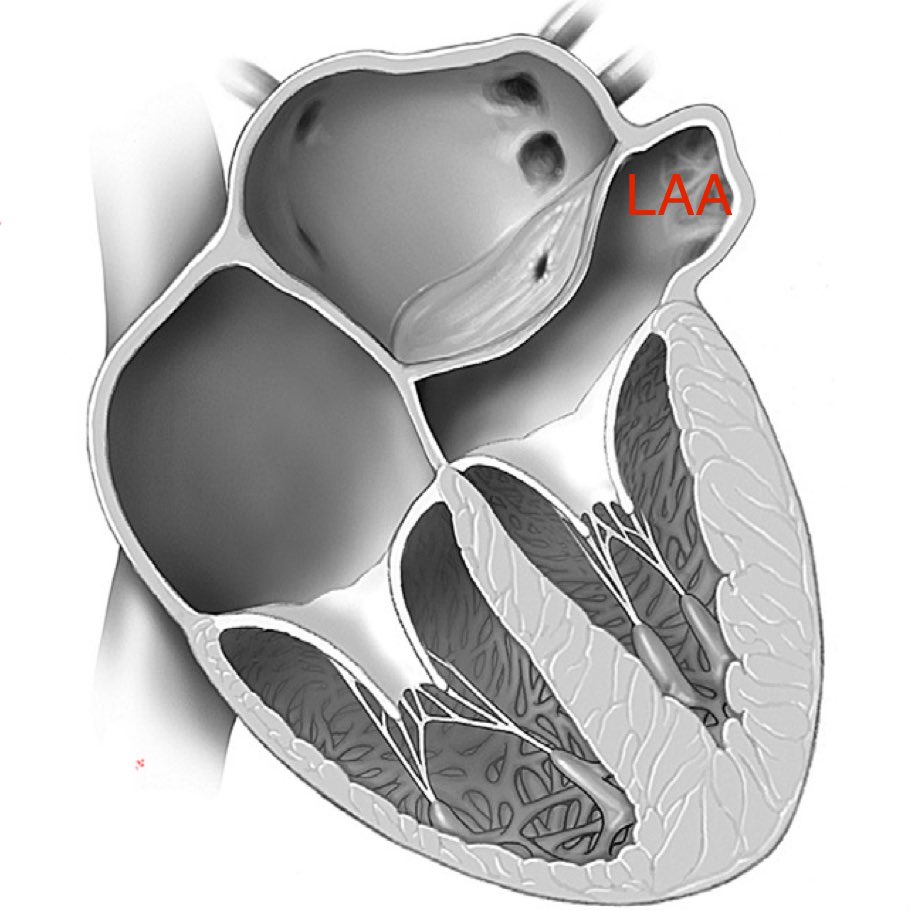 Ritu Thamman MD (@iamritu) on Twitter photo <a href="/OungSavly/">Oung Savly MD FACC FESC FASE FAPSC 🇰🇭</a> <a href="/escardio/">European Society of Cardiology</a> <a href="/WGACHDChair/">ESC WG on ACHD Chairperson</a> <a href="/echoleolopez/">Leo Lopez</a> <a href="/EACVIPresident/">EACVI President</a> <a href="/dkthekkoott/">Deepak Thekkoott #am-writing MD</a> <a href="/loomba_rohit/">Rohit loomba</a> <a href="/AEPCcongenital/">AEPC - Paediatric and Congenital Cardiology</a> <a href="/alexsfelixecho/">Alex Felix</a> <a href="/alex1708ander/">Alexander Mladenow MD</a> <a href="/CardioNeo/">NeoCardioLab - Gabriel Altit</a> <a href="/Prasannasimha/">Prasannasimha🇮🇳</a> <a href="/DrRajeshG1/">Dr G Rajesh (Gopalan Nair Rajesh).</a> <a href="/swatigar/">Swati Garekar</a> <a href="/ASE360/">American Society of Echocardiography</a> <a href="/ACCinTouch/">American College of Cardiology</a> cor triatriatum sinister lies above LAA & this membrane/curved shelf moves TOWARDs mitral valve in diastole & pulm veins drain proximal to this membrane #echofirst <a href="/OungSavly/">Oung Savly MD FACC FESC FASE FAPSC 🇰🇭</a> <a href="/escardio/">European Society of Cardiology</a> <a href="/WGACHDChair/">ESC WG on ACHD Chairperson</a> <a href="/echoleolopez/">Leo Lopez</a> <a href="/EACVIPresident/">EACVI President</a> <a href="/dkthekkoott/">Deepak Thekkoott #am-writing MD</a> <a href="/loomba_rohit/">Rohit loomba</a> <a href="/AEPCcongenital/">AEPC - Paediatric and Congenital Cardiology</a> <a href="/alexsfelixecho/">Alex Felix</a> <a href="/alex1708ander/">Alexander Mladenow MD</a> <a href="/CardioNeo/">NeoCardioLab - Gabriel Altit</a> <a href="/Prasannasimha/">Prasannasimha🇮🇳</a> <a href="/DrRajeshG1/">Dr G Rajesh (Gopalan Nair Rajesh).</a> <a href="/swatigar/">Swati Garekar</a> <a href="/ASE360/">American Society of Echocardiography</a> <a href="/ACCinTouch/">American College of Cardiology</a> cor triatriatum sinister lies above LAA & this membrane/curved shelf moves TOWARDs mitral valve in diastole & pulm veins drain proximal to this membrane #echofirst
