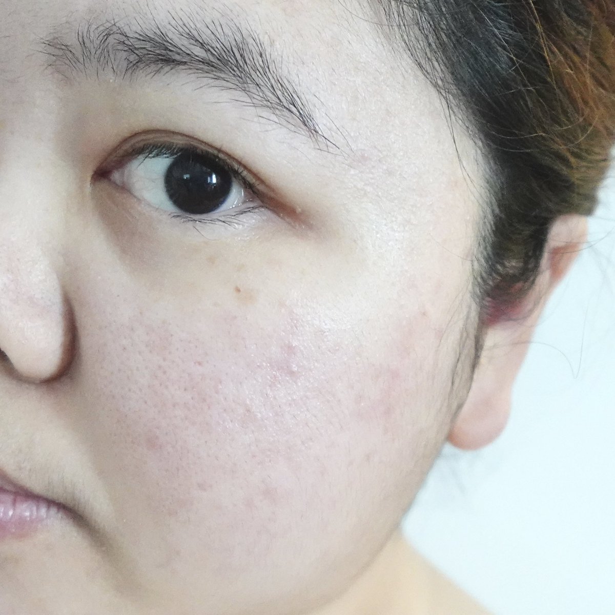 เอาจริงนะ สิ่งนี้ทุกคนต้องมีไว้ใช้ปราบสิวค่ะค่ะ! ใช้มาตั้งแต่วัยรุ่นนะ Effaclar Duo+M ของลาโรช เป็นมอยเจอร์ไรเซอร์ที่บำรุงได้ ปลอบประโลมผิวดี ลดสิวจากต้นตอ เพราะมีตัว PHYLOBIOMA โมเลกุลที่ช่วยปรับสมดุลผิว ลดความมัน ทำให้ช่วยลดการเกิดสิว แล้วช่วยลดรอยจากสิวด้วย ก็คือครบ จบ หมดก็ซื้อวนไป หลอดที่ n 🙌🏻 ต้องมี ต้องซื้อ ต้องซ้ำ !