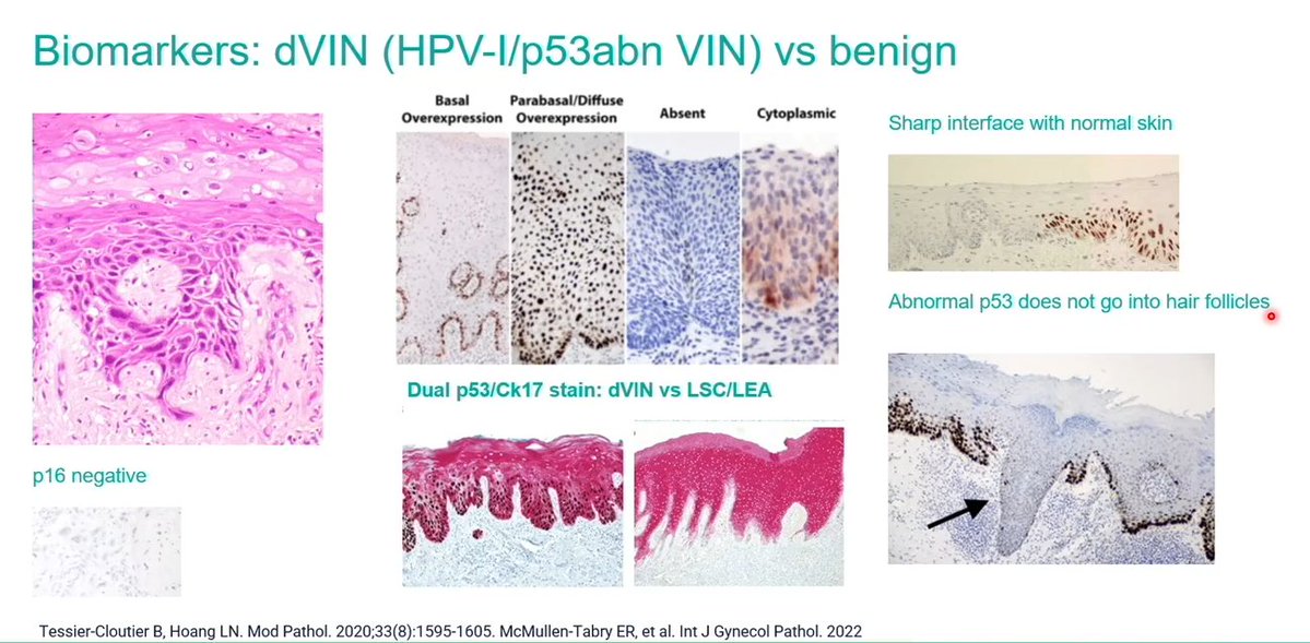 Vulva-p53IHC
Abnormal p53 does not go into hair follicles

Credit pic Dr. Rakislova #USCAP25 #pathology #PathX