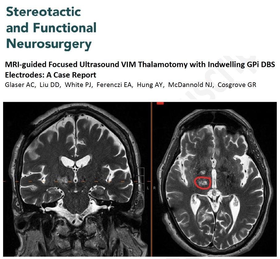 Can you 'zap' the brain with focused ultrasound if you have a DBS lead in place? A new possible twist for cases w/ both tremor and Parkinson's. For the first time, at least that I have read, focused ultrasound (FUS) thalamotomy was successfully used in a person who already had