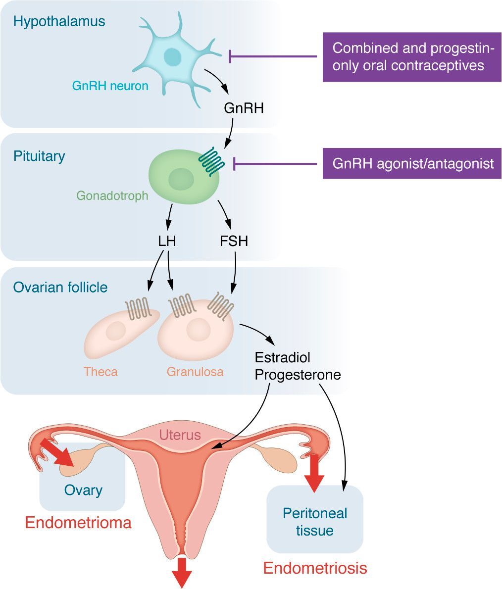 Journal of Clinical Investigation (@jclinicalinvest) on Twitter photo Endometriosis and its links to ovulation: jci.org/articles/view/…
Endo is a chronic, painful condition that remains difficult to diagnose and adequately manage.
@SerdarBulun's review asserts that suppressing ovulation should be a goal for managing this disease. <a href="/NUFeinbergMed/">Northwestern Feinberg School of Medicine</a> Endometriosis and its links to ovulation: jci.org/articles/view/…
Endo is a chronic, painful condition that remains difficult to diagnose and adequately manage.
@SerdarBulun's review asserts that suppressing ovulation should be a goal for managing this disease. <a href="/NUFeinbergMed/">Northwestern Feinberg School of Medicine</a>