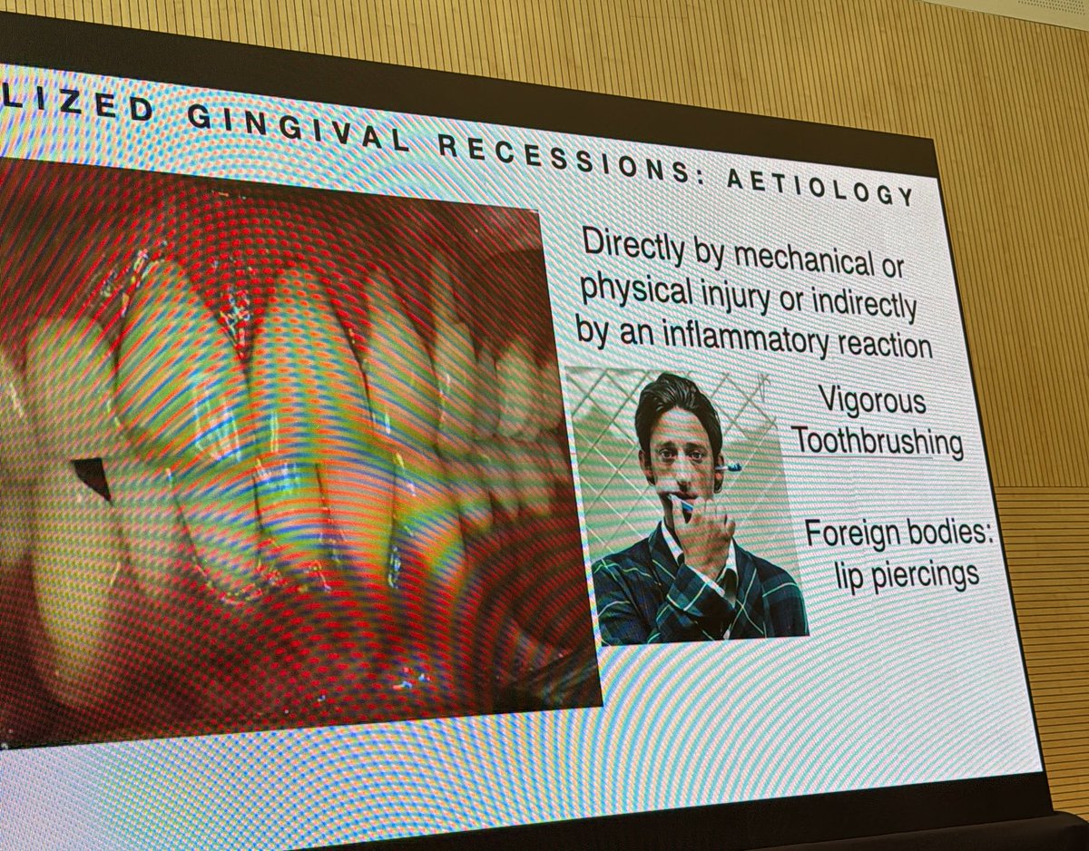 PerioMX's tweet image. Si existe una recesión que no afecta a la estética y no tiene hipersensibilidad y no tiene asociación con lesión cervical solo se pueden vigilar sin necesidad de operarlos #DrMarianoSanz