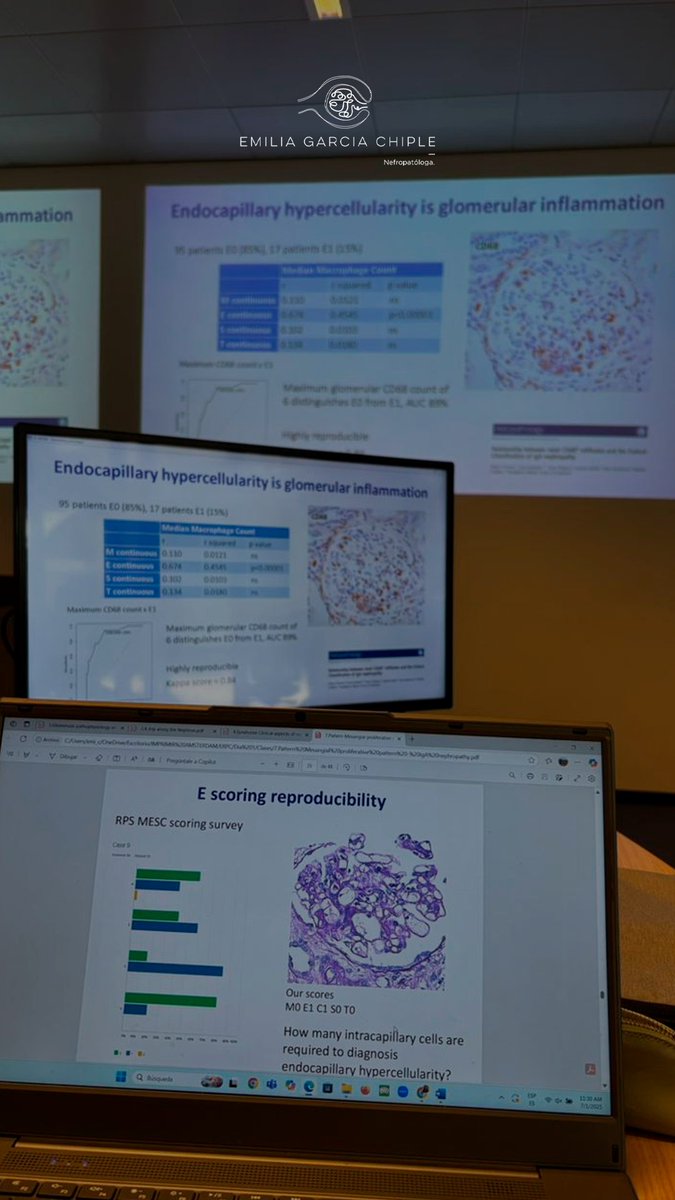nephropath_gc's tweet photo. Revisando el score MEST-C para nefropatía por IgA con el Dr. Ian Roberts, uno de los expertos que participó en su desarrollo.
Nuevas ideas y elementos en discusión durante el European Renal Pathology Course 🇳🇱
#RenalPathology #IgANephropathy #MESTC #Nephrology #Pathology https://t.co/2KSCmqvNn5