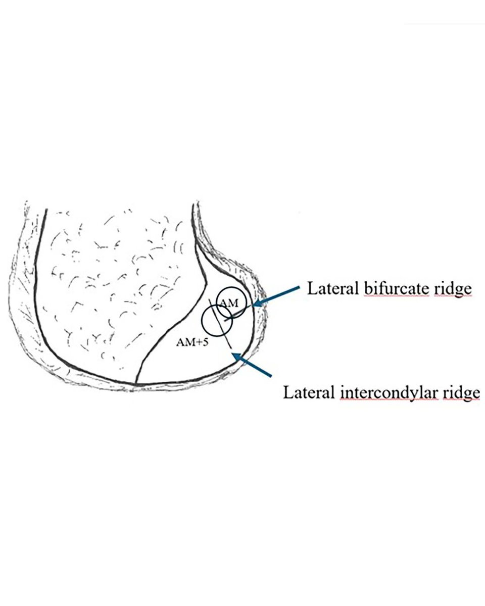 The knowledge obtained through this study can be used to avoid tunnel combinations in anterior cruciate ligament reconstructions with unfavourable outcomes.

#BJO #ACL #Knee #Surgery #Research

ow.ly/xZIL50WiilL
