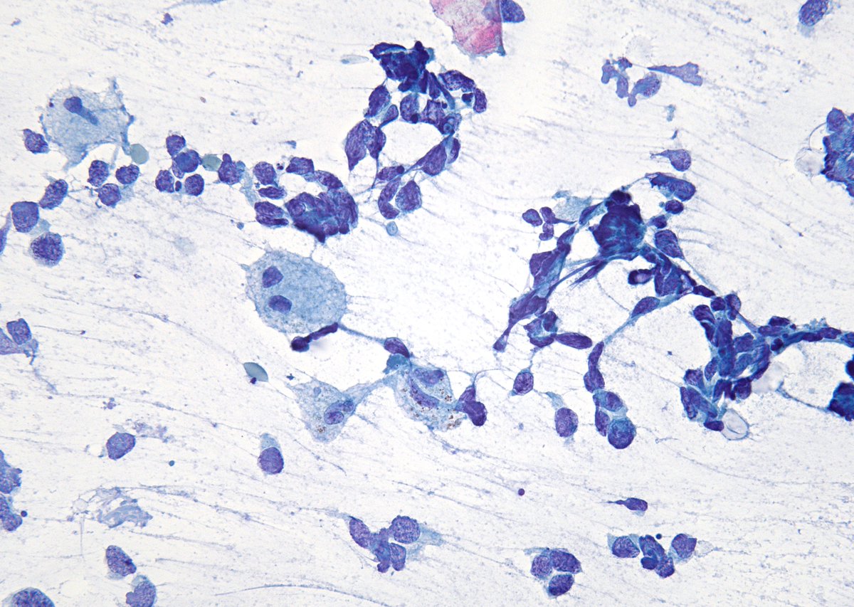 THYROID with metastatic lung "Small Cell Carcinoma". Macrophages provide a good size reference. DD - Medullary CA uncommonly may have a "small cell" phenotype as well as mets from other neuroendocrine tumors (I've seen at least two cases of Merkel cell CA mets to thyroid). (FNA)