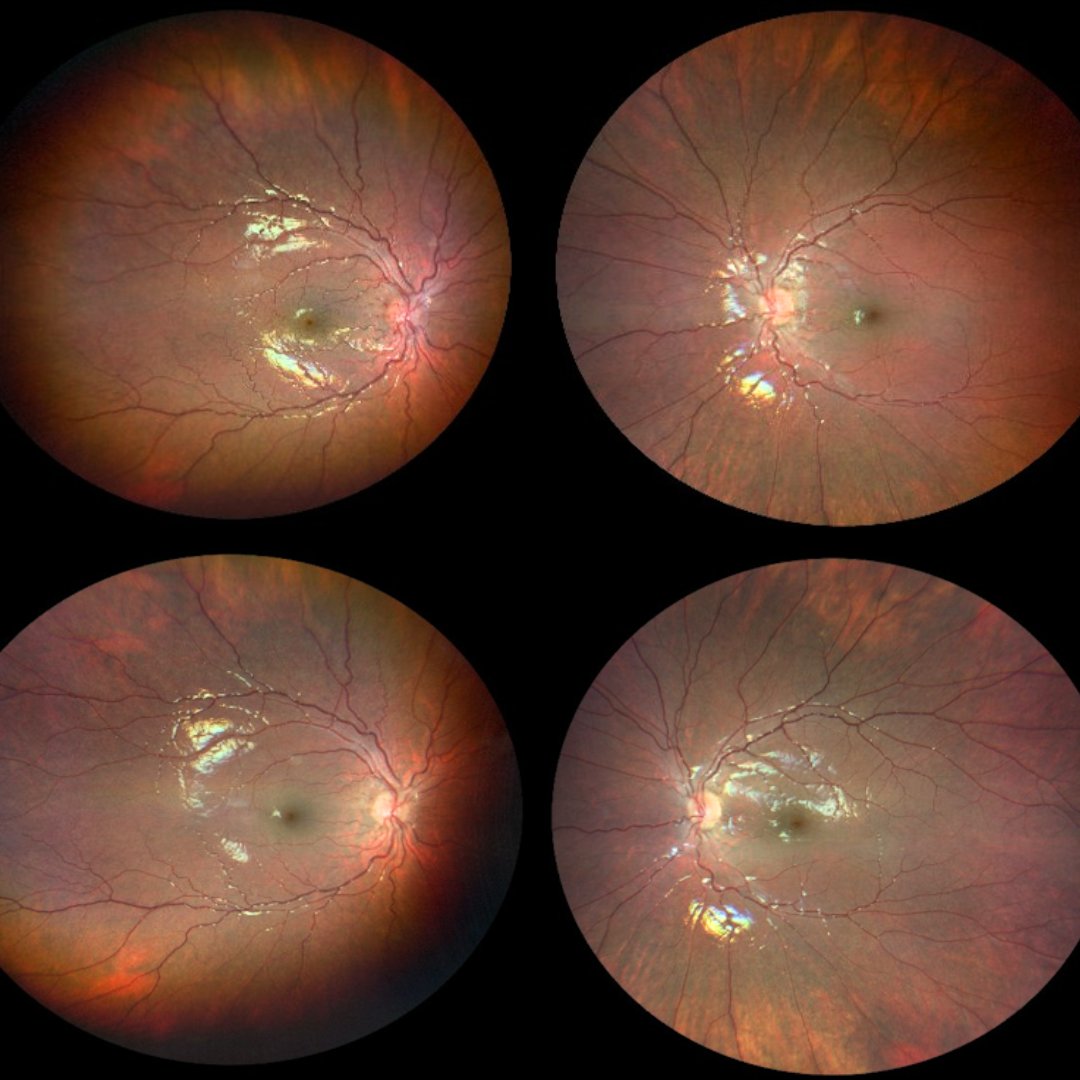 Pediatric nutritional deficiencies can directly affect ocular health and function. Pictured here is a child with vitamin A deficiency, showing optic nerve edema and resolution before &amp; after treatment.

Learn more: reviewofophthalmology.com/article/ocular…
#ophthalmology #ophthalmologist #eyecare