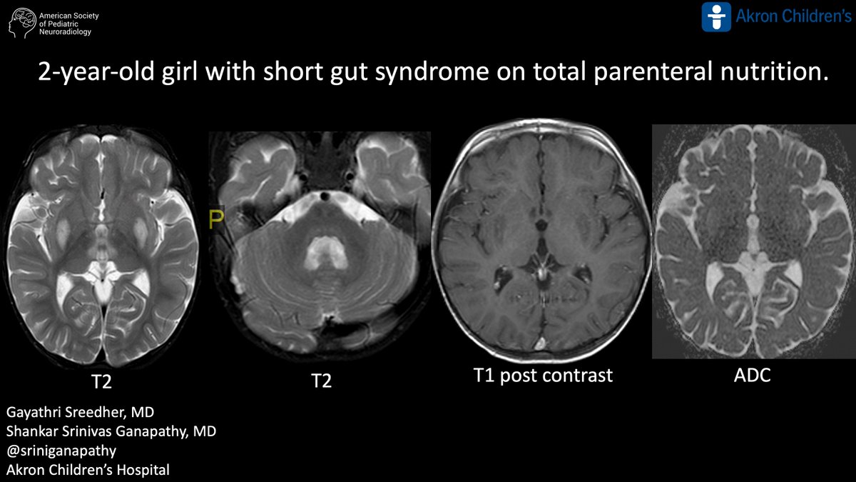 Case of the week: 2-year-old girl with short gut syndrome on total parenteral nutrition bit.ly/4kZRq1F Gayathri Sreedher, MD, Shankar Srinivas Ganapathy, MD, Akron Children’s Hospital #PediNeuroRad #MedEd #FOAMrad #PedsRad