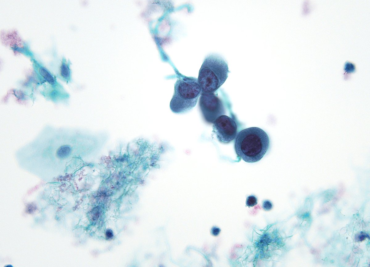 Non-keratinizing Squamous Cell Carcinoma with background tumor diathesis. "Hard" cytoplasm is quite evident. (PAP test, SurePath)