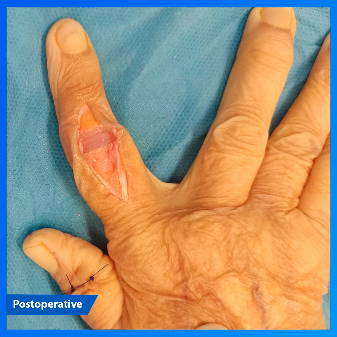 medcomtech_sa's tweet photo. Dr. Toni García con la Dra. Juana Medina en el H. de Palamós, operaron a una paciente de 59 años, con artritis reumatoide muy agresiva + dolor y deformidad con desviación cubital de interfalángica proximal, del dedo índice derecho. Se implantó
prótesis BRM Digitalis #medcomtech https://t.co/3PV1uIBm5h