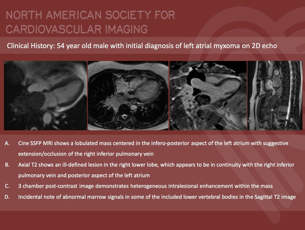 NASCISociety's tweet image. #NASCI Case Series
Case 84
Courtesy of Jerald S. Lim @jgl_md from St. Luke’s Medical Center, Philippines
What is the right answer?
#whyCMR #YesCCT
@GregKicska @JRevRad1 @dianalitmano @DanielVargasMD @kirschj @prachipagarwal @AwsHamid5 @EscrOffice @CarlottaOnnis @DeCeccoCN