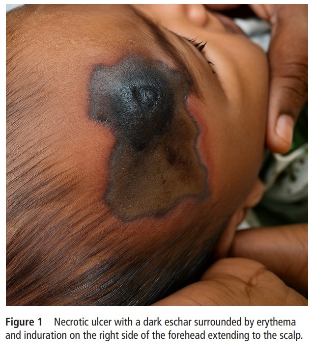 NICU_Musings's tweet image. Ecthyma Gangrenosum in an 8 month old
Cultures from the blood and lesion grew Pseudomonas aeruginosa
At 14 days of treatment completely resolved
pubmed.ncbi.nlm.nih.gov/40555461/
#IDTwitter #neoTwitter