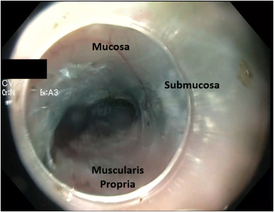 VideoGIE Journal (@videogie) on Twitter photo Kambiz Kadkhodayan and Shayan Irani examine "Endoscopic truncal vagotomy. Exploring the fourth space. A technical feasibility study in a porcine model." videogie.org/article/S2468-…
#GITwitter
<a href="/KambizKadkhoda2/">Kambiz Kadkhodayan</a> Kambiz Kadkhodayan and Shayan Irani examine "Endoscopic truncal vagotomy. Exploring the fourth space. A technical feasibility study in a porcine model." videogie.org/article/S2468-…
#GITwitter
<a href="/KambizKadkhoda2/">Kambiz Kadkhodayan</a>
