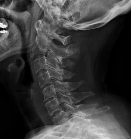 TRAUMA X-RAY 36: Forced neck extension injury. What is the injury? Answer buff.ly/3DZzEec
