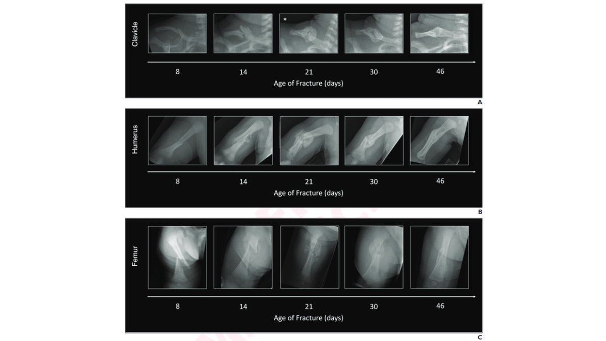 arosenkrantzmd's tweet image. New @AJR_Radiology Accepted Manuscript:
"Use of a Template-Matching Clavicle Fracture Atlas for Surrogate Dating of Humeral and Femoral Fractures in Young Infants: A Six-Reader Study"
By Dr @jadeneder & team @boschildrensrad
ajronline.org/doi/10.2214/AJ…