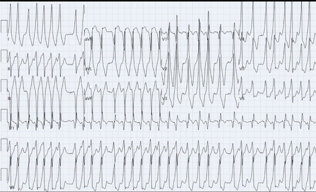 What is “pre-excited” atrial fibrillation? It’s AF in a patient with ...