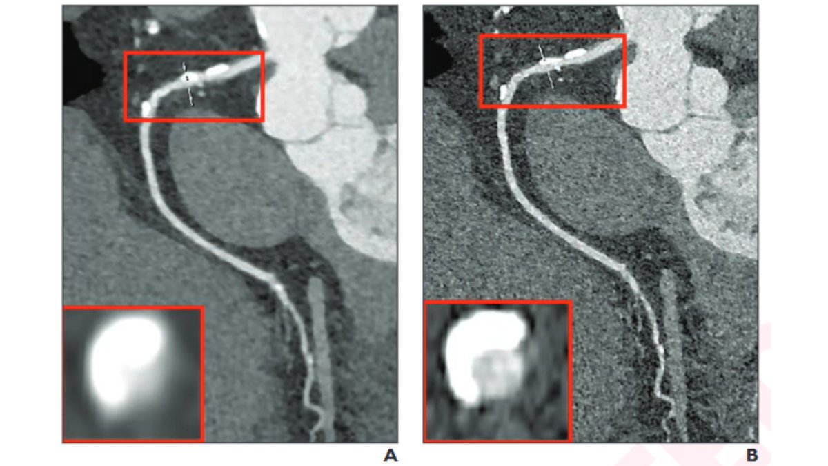arosenkrantzmd's tweet image. New @AJR_Radiology Accepted Manuscript:
"PCD CTA in Standard and Ultrahigh-Resolution Modes for Diagnosing Coronary Artery Stenosis Using Invasive Angiography as the Reference: A Prospective Study"
By Drs Wang, Li, Yang, & team @sjtu1896
ajronline.org/doi/10.2214/AJ…