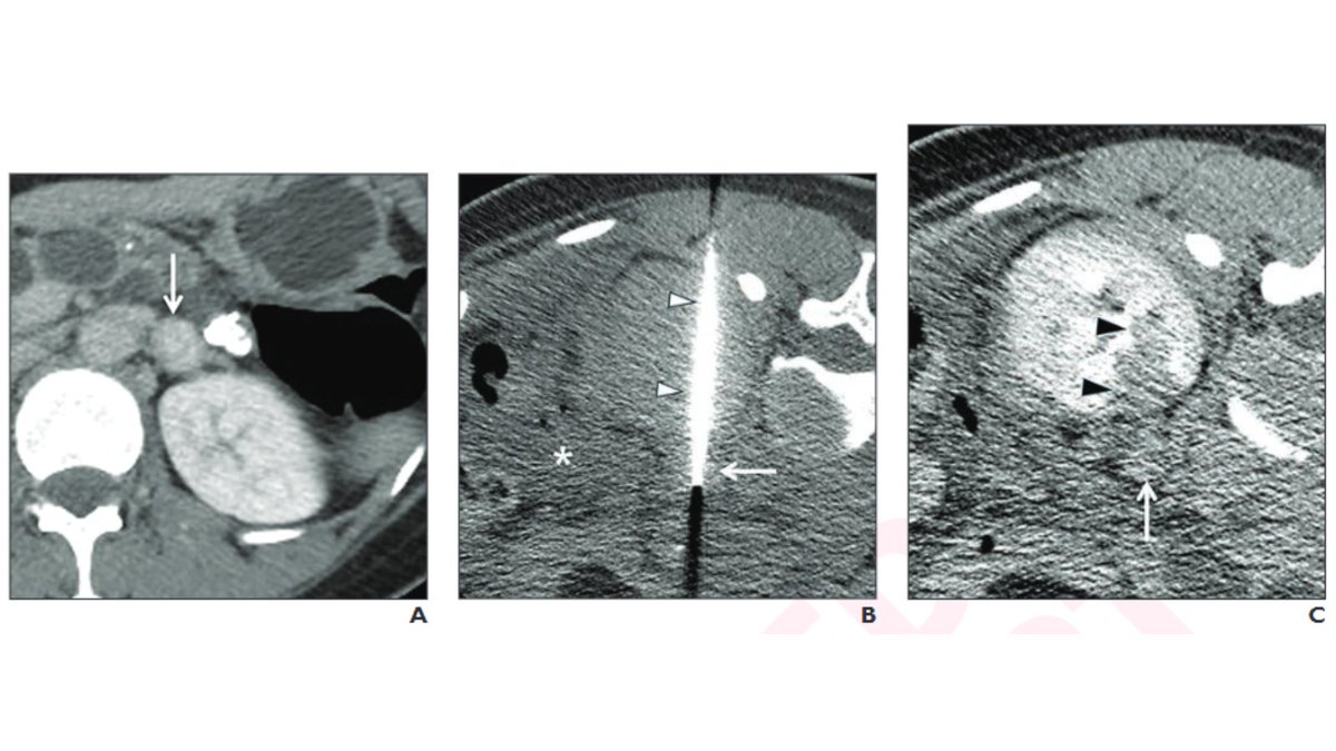 arosenkrantzmd's tweet image. New @AJR_Radiology Accepted Manuscript:
"Safety of Transrenal CT-Guided Radiofrequency Ablation of Left Adrenal Masses"
By Dr Park @SKKUni1398
ajronline.org/doi/10.2214/AJ…