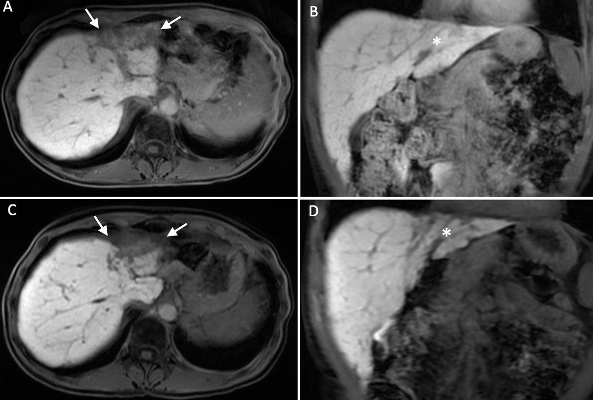 MedBlendPub's tweet image. 💡#CaseChallenge
📌Pseudocirrhosis from hepatic mets - 43F w/ breast cancer
📅 Initial MRI: Normal contour, confluent mets in L lobe
⏭️ 6 Mo: left L atrophy with confluent hypointense area + surface irregularity
🧠 Pseudocirrhosis — from treated hepatic mets
#RadRes #MedTwitter