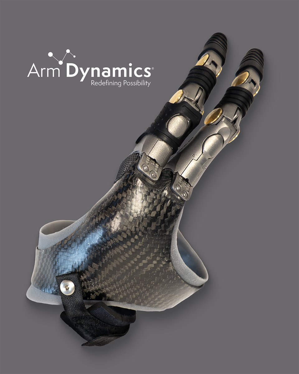 This patient had some bone in his residual knuckle that  bothered him when he wore the initial prosthesis that our team created for him. For his take-home prosthesis, we added silicone to cushion the knuckle.