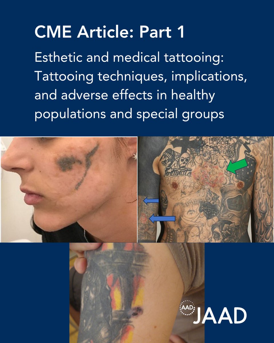 Part 1 of this CME article dives into the history, culture, chemistry, risks and technique of tattoos helping individuals make informed choices and giving physicians the knowledge to guide patients: bit.ly/44JInMo