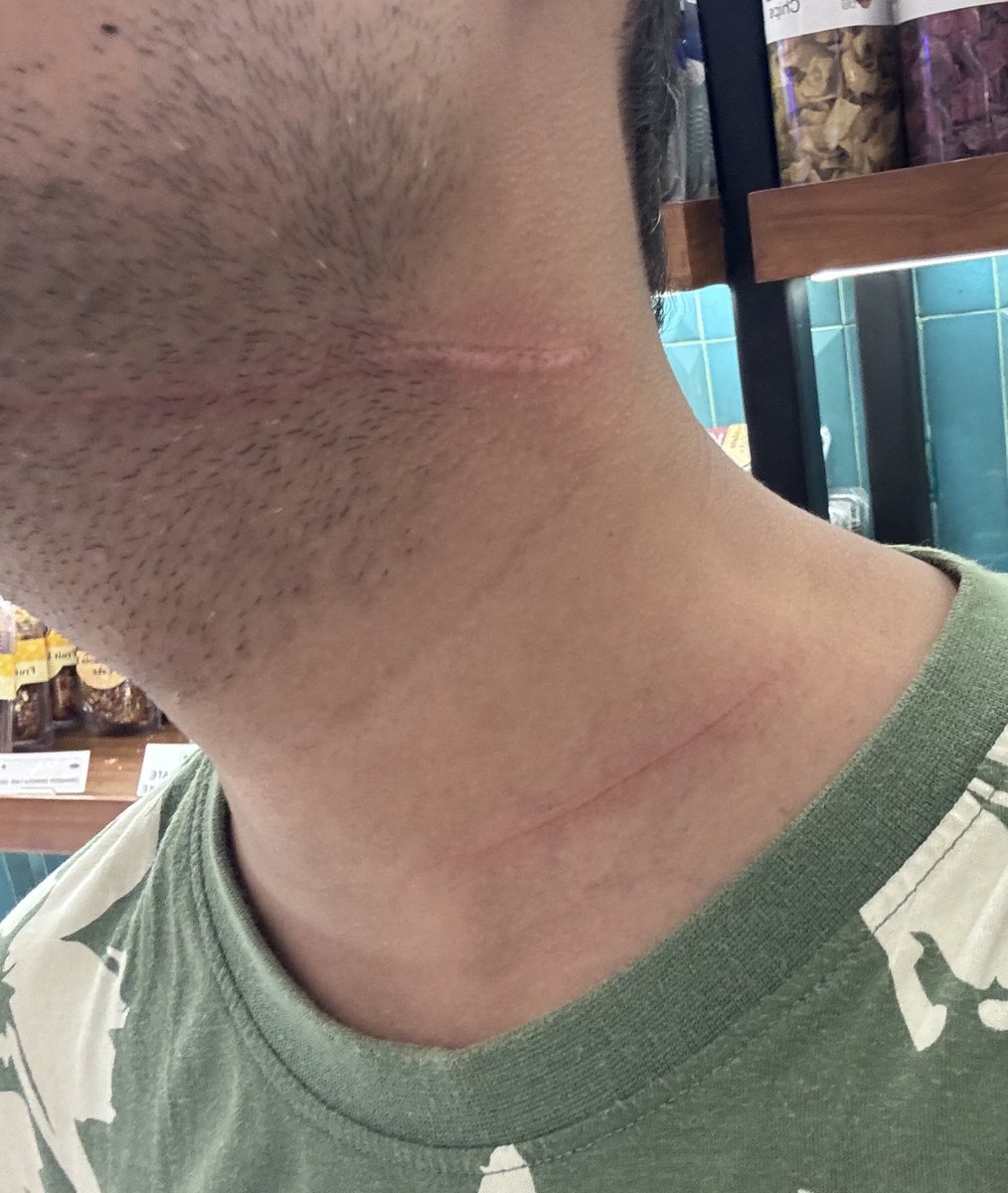 Gautam_Adv28's tweet photo. 1/2 Today in Prayagraj while returning from a meeting, suffered serious neck injury by banned Kite Manjha while riding my bike. Somehow managed to put my thumb between the manjha &amp; my neck that act saved my life.
@prayagraj_pol @Uppolice @UPPCBLKO @CPCB_OFFICIAL @myogiadityanath https://t.co/BpdSubXzGr