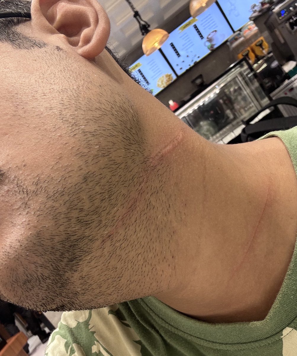 Gautam_Adv28's tweet photo. 1/2 Today in Prayagraj while returning from a meeting, suffered serious neck injury by banned Kite Manjha while riding my bike. Somehow managed to put my thumb between the manjha &amp; my neck that act saved my life.
@prayagraj_pol @Uppolice @UPPCBLKO @CPCB_OFFICIAL @myogiadityanath https://t.co/BpdSubXzGr