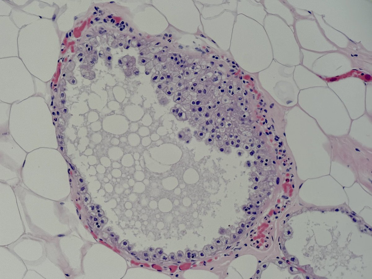 MBBS_Pathology's tweet image. Milk is not often seen being produced in a post-menopausal breast but this was a surprise today in a wide local excision. Notice the cream globules in the lumen with surrounding lactational changes.
#pathology