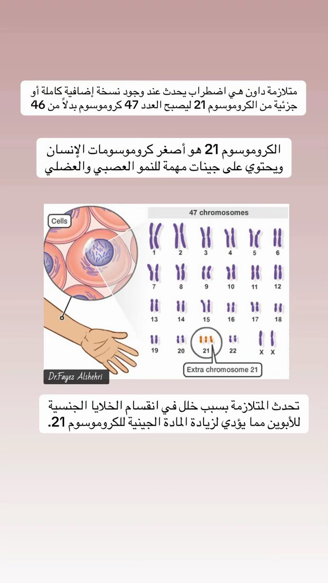 Dr_Fayez_sh's tweet photo. متلازمة داون
جميعنا نعرف اسم هذه المتلازمة ونعرف اصحابها الجميلين 🤍
ولكن ماهي اسباب حدوثها في علم الوراثة؟

في الصور التالية سنرى كيفية حدوث متلازمة داون على مستوى الكروموسومات

#متلازمة #متلازمة_داون #داون #dawn #genetics #chromosomes #genes #mutation #nipt https://t.co/vxMT4e6ThI