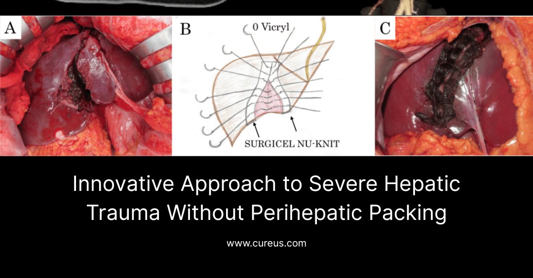 New trauma case: A 16-year-old with liver &amp; kidney injuries was treated without perihepatic packing.
TAE + absorbable hepatorrhaphy
Smooth recovery
A safer alternative for blunt hepatic trauma.
Read the full article now: hubs.la/Q03vCdDy0
#Cureus #SurgicalInnovation