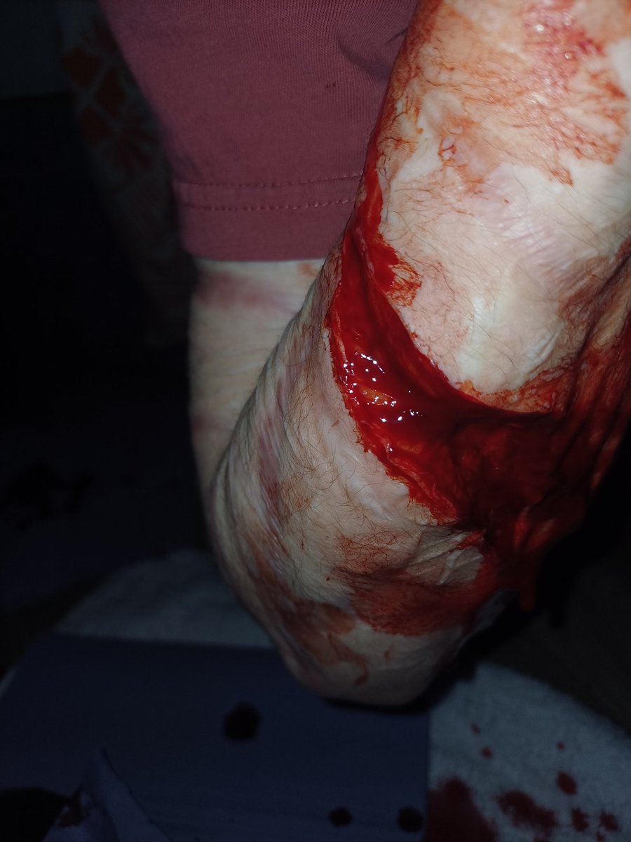 Ana_bre_'s tweet photo. TW SELF HARM // ok soooo... oops? https://t.co/THmhm3S0kn